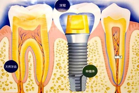 种植牙齿有什么坏处-义齿厂家