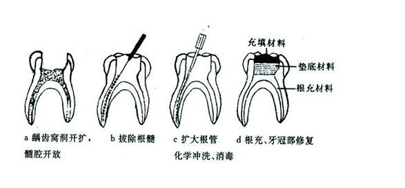 做根管治疗大概要多久-成都义齿厂家