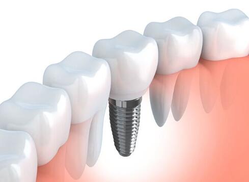 整个种植牙修复过程要多久-四川义齿厂家