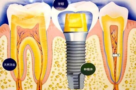种植牙齿有什么坏处-义齿厂家