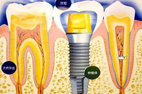 种植牙齿有什么坏处-义齿厂家