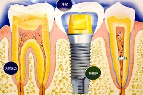 种植牙齿有什么坏处-义齿厂家