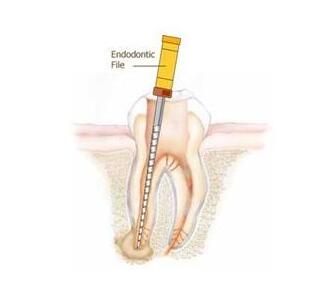 什么叫根管治疗-四川义齿厂家