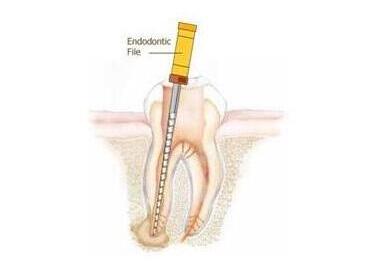 什么叫根管治疗-成都义齿厂家