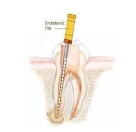 什么叫根管治疗 | 四川义齿厂家