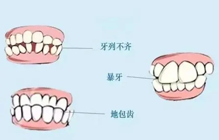 牙齿不齐会带来哪些危害 | 成都义齿厂家