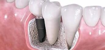脱落的牙齿用种植牙修复有哪些优点 | 义齿厂家